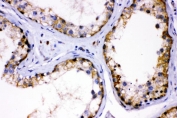 IHC staining of FFPE human testis cancer tissue with AMHR2 antibody. HIER: boil tissue sections in pH8 EDTA for 20 min and allow to cool before testing.