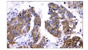 IHC staining of FFPE human ovarian cancer tissue with AMHR2 antibody. HIER: boil tissue sections in pH8 EDTA for 20 min and allow to cool before testing.