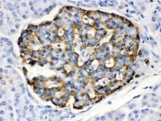 IHC testing of FFPE human pancreatic cancer tissue with APOBEC3G antibody at 1ug/ml. HIER: steam in pH6 citrate buffer and allow to cool prior to staining.
