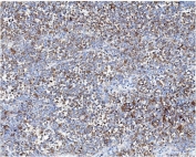 IHC staining of FFPE human melanoma with ARF6 antibody. HIER: boil tissue sections in pH8 EDTA for 20 min and allow to cool before testing.