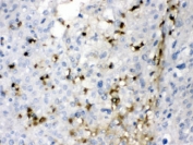 IHC testing of FFPE human liver cancer tissue with CA2 antibody at 1ug/ml. HIER: steam in pH6 citrate buffer and allow to cool prior to staining.