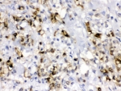 IHC testing of FFPE human gastric cancer tissue with CA2 antibody at 1ug/ml. HIER: steam in pH6 citrate buffer and allow to cool prior to staining.