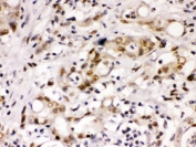 IHC testing of FFPE human intestine cancer tissue with Cyclin T1 antibody at 1ug/ml. HIER: steam in pH6 citrate buffer and allow to cool prior to staining.