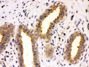 IHC testing of FFPE human breast cancer tissue with TCP1 theta antibody at 1ug/ml. HIER: steam in pH6 citrate buffer and allow to cool prior to staining.