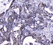 IHC staining of FFPE human intestinal cancer with Cdk6 antibody at 1ug/ml. HIER: boil tissue sections in pH6, 10mM citrate buffer, for 10-20 min followed by cooling at RT for 20 min.