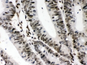 IHC testing of FFPE human intestine cancer tissue with CIITA antibody at 1ug/ml. HIER: steam in pH6 citrate buffer and allow to cool prior to staining.
