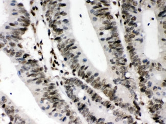IHC testing of FFPE human intestine cancer tissue with CIITA antibody at 1ug/ml. HIER: steam in pH6 citrate buffer and allow to cool prior to staining.