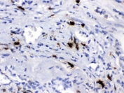 IHC testing of FFPE human lung cancer tissue with Carboxypeptidase B2 antibody at 1ug/ml. HIER: steam in pH6 citrate buffer and allow to cool prior to staining.