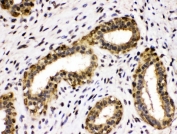IHC staining of FFPE human breast cancer with ADH5 antibody. HIER: boil tissue sections in pH6, 10mM citrate buffer, for 20 min and allow to cool before testing.