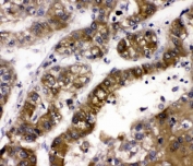 IHC staining of FFPE human liver cancer with ADH5 antibody. HIER: boil tissue sections in pH6, 10mM citrate buffer, for 20 min and allow to cool before testing.