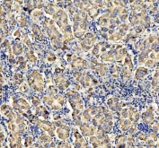 IHC staining of FFPE human liver cancer tissue with ACADVL antibody. HIER: boil tissue sections in pH8 EDTA for 20 min and allow to cool before testing.