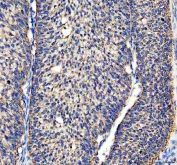 IHC staining of FFPE human ovarian cancer tissue with ACADVL antibody. HIER: boil tissue sections in pH8 EDTA for 20 min and allow to cool before testing.