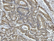 IHC testing of FFPE human colonic adenocarcinoma tissue with ATP Citrate Lyase antibody at 2ug/ml. HIER: steam sections in pH8 EDTA for 20 min.