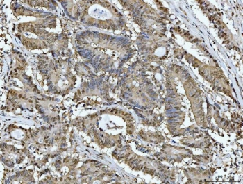IHC testing of FFPE human colonic adenocarcinoma tissue with ATP Citrate Lyase antibody at 2ug/ml. HIER: steam sections in pH8 EDTA for 20 min.