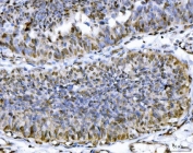 IHC testing of FFPE human colon cancer tissue with ATP Citrate Lyase antibody at 2ug/ml. HIER: steam sections in pH8 EDTA for 20 min.