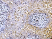 IHC testing of FFPE human laryngeal squamous cell carcinoma tissue with ATP Citrate Lyase antibody at 2ug/ml. HIER: steam sections in pH8 EDTA for 20 min.