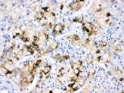 IHC testing of FFPE human liver cancer tissue with ACSL1 antibody at 1ug/ml. HIER: steam sections in pH6 citrate buffer for 20 min.