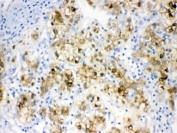 IHC testing of FFPE human liver cancer tissue with Alcohol dehydrogenase antibody. HIER: steam sections in pH6 citrate buffer for 20 min.