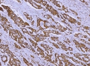 IHC staining of FFPE human colonic adenocarcinoma with ALDH1B1 antibody. HIER: boil tissue sections in pH8 EDTA for 20 min and allow to cool before testing.