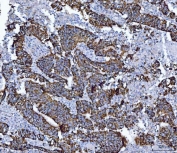 IHC staining of FFPE human colon cancer with ALDH1B1 antibody. HIER: boil tissue sections in pH8 EDTA for 20 min and allow to cool before testing.