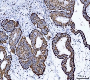 IHC staining of FFPE human endometrial adenocarcinoma with ALDH1B1 antibody. HIER: boil tissue sections in pH8 EDTA for 20 min and allow to cool before testing.