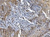 IHC staining of FFPE human laryngeal squamous cell carcinoma with ALDH1B1 antibody. HIER: boil tissue sections in pH8 EDTA for 20 min and allow to cool before testing.