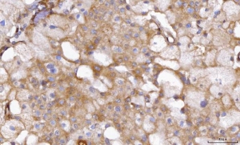 IHC staining of FFPE human renal cell carcinoma tissue with ABP1 antibody. HIER: boil tissue sections in pH8 EDTA for 20 min and allow to cool before testing.