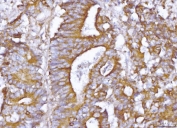 IHC staining of FFPE human colonic adenoma tissue with ABP1 antibody. HIER: boil tissue sections in pH8 EDTA for 20 min and allow to cool before testing.