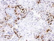 IHC testing of FFPE human osteosarcoma with CA3 antibody at 1ug/ml. HIER: steam section in pH6 citrate buffer for 20 min.