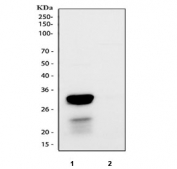 IHC testing of FFPE human intestinal cancer with Cathepsin G antibody at 1ug/ml. HIER: steam section in pH6 citrate buffer for 20 min.