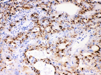 IHC testing of FFPE human liver cancer tissue with CYP3A4 antibody at 1ug/ml. HIER: steam section in pH6 citrate buffer for 20 min.~