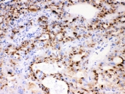 IHC testing of FFPE human liver cancer tissue with CYP3A4 antibody at 1ug/ml. HIER: steam section in pH6 citrate buffer for 20 min.