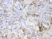 IHC testing of FFPE human lung cancer tissue with DHODH antibody at 1ug/ml. HIER: steam section in pH6 citrate buffer for 20 min.