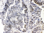 IHC testing of FFPE human intestinal cancer tissue with E2F4 antibody at 1ug/ml. HIER: steam section in pH6 citrate buffer for 20 min.