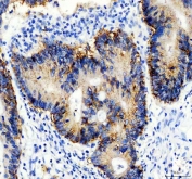 IHC staining of FFPE human colon cancer tissue with EpCAM antibody. HIER: boil tissue sections in pH8 EDTA for 20 min and allow to cool before testing.