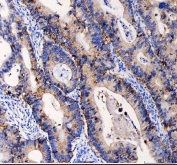 IHC staining of FFPE human colon cancer tissue with EpCAM antibody. HIER: boil tissue sections in pH8 EDTA for 20 min and allow to cool before testing.