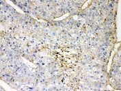 IHC testing of FFPE human liver cancer tissue with GNB1 antibody at 1ug/ml. HIER: steam section in pH6 citrate buffer for 20 min.