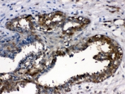 IHC testing of FFPE human breast cancer tissue with LDHA antibody at 1ug/ml.  HIER: steam section in pH6 citrate buffer for 20 min.