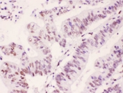 IHC testing of FFPE human intestinal cancer tissue with PML antibody at 1ug/ml.  HIER: steam section in pH6 citrate buffer for 20 min.