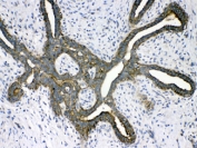 IHC testing of FFPE human breast cancer tissue with PSAT1 antibody at 1ug/ml. HIER: steam section in pH6 citrate buffer for 20 min.