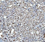 IHC testing of FFPE human intestine cancer tissue with PSAT1 antibody at 1ug/ml. HIER: steam section in pH6 citrate buffer for 20 min.