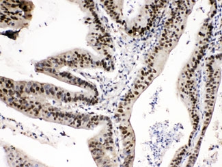 IHC testing of FFPE human intestine cancer tissue with PSAT1 antibody at 1ug/ml. HIER: