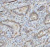 IHC staining of FFPE human rectum adenocarcinoma tissue with PSMA1 antibody. HIER: boil tissue sections in pH8 EDTA for 20 min and allow to cool before testing.