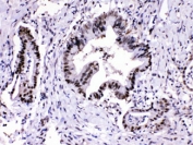 IHC testing of FFPE human intestine cancer tissue with PSMA3 antibody at 1ug/ml. HIER: steam section in pH6 citrate buffer for 20 min.