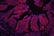 Immunofluorescent staining of FFPE human ovarian cancer tissue with MPS1 antibody (red) at 1ug/ml and DAPI nuclear stain (blue). HIER: steam section in pH6 citrate buffer for 20 min.