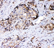 IHC staining of FFPE human breast cancer with RPSA antibody. HIER: boil tissue sections in pH6, 10mM citrate buffer, for 20 min and allow to cool before testing.