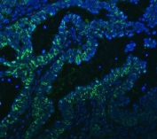 Immunofluorescent staining of FFPE human intestinal cancer tissue with PC4 antibody (green) and DAPI nuclear stain (blue). HIER: steam section in pH8 ETDA for 20 min.