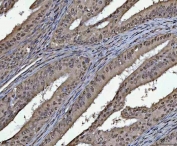 IHC staining of FFPE type 1 human endometrioid adenocarcinoma tissue with PC4 antibody. HIER: boil tissue sections in pH8 EDTA for 20 min and allow to cool before testing.