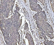 IHC staining of FFPE human esophageal squamous carcinoma tissue with PC4 antibody. HIER: boil tissue sections in pH8 EDTA for 20 min and allow to cool before testing.