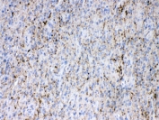 IHC testing of FFPE human glioma tissue with Synapsin 1 antibody at 1ug/ml. HIER: steam section in pH6 citrate buffer for 20 min.